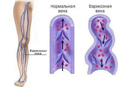 Varice tratament la domiciliu, remedii populare (acasă) Varice tratament la domiciliu, remedii populare