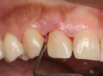 gingiile inflamate sunt dureroase și ce să facă și cum să trateze