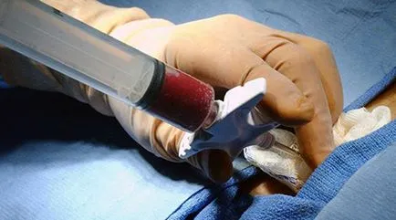 Inflamarea simptomele comune umăr și tratamentul capsulei articulare și căile de atac populare nervoase