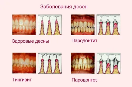 gingiile inflamate sunt dureroase și ce să facă și cum să trateze