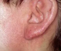 Totul despre dermatita de contact si tratamentul acesteia