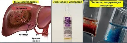 Chimioterapia metastaze în ficat și reconstituire după chimioterapie