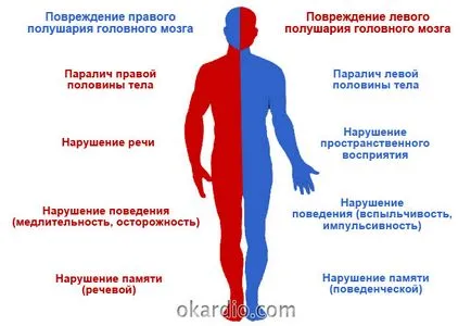 Toate simptomele de accident vascular cerebral și primele semne ale unei analize complete (accident vascular cerebral) Toate simptomele unui accident vascular cerebral și primele semne ale unei revizuiri complete