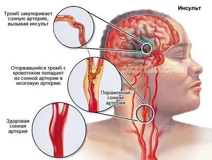 Toate simptomele de accident vascular cerebral și primele semne ale unei analize complete (accident vascular cerebral) Toate simptomele unui accident vascular cerebral și primele semne ale unei revizuiri complete