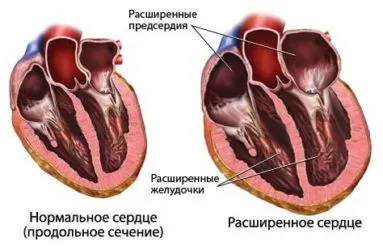 Simptomele cronice insuficienta cardiaca si tratament