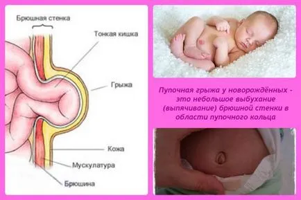 Parcelele pe hernie ombilicală citit