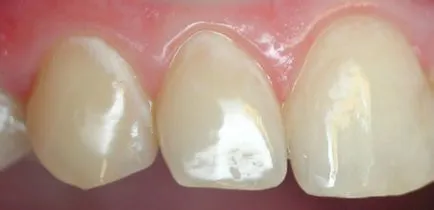 cariilor dentare, in stadiul alb tratament la fața locului, cauze, diagnostic si prevenire