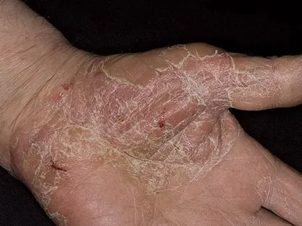 Alergia la această mână care Alergia la această mână care