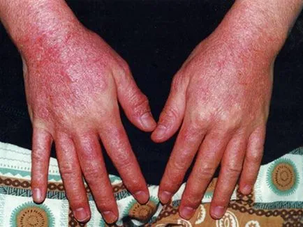 Alergia la această mână care Alergia la această mână care
