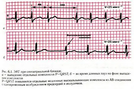 Ce este bloc cardiac incomplet Ce este bloc cardiac incomplet