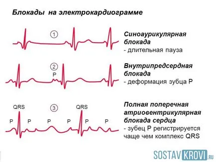 Ce este bloc cardiac incomplet Ce este bloc cardiac incomplet