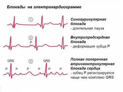 Ce este bloc cardiac incomplet