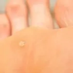 Cum de a elimina negii plantare Cum de a elimina negii plantare