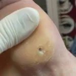 Cum de a elimina negii plantare Cum de a elimina negii plantare
