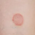 Cum de a elimina negii plantare Cum de a elimina negii plantare