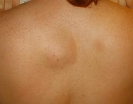 Umflaturi sub piele, care este Umflaturi sub piele, care este