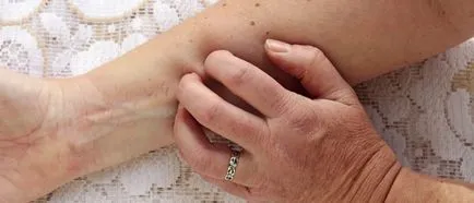 De ce moli mâncărime De ce moli mâncărime