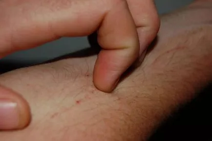 De ce moli mâncărime De ce moli mâncărime