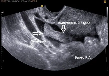 Salpingografie ce este Salpingografie ce este
