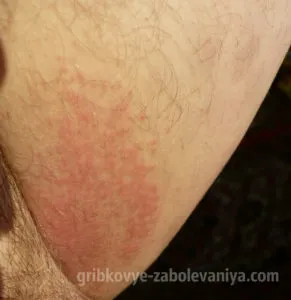 Tratamentul ciuperca în zona abdomenului