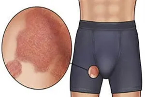 Tratamentul ciuperca în zona abdomenului Tratamentul ciuperca în zona abdomenului