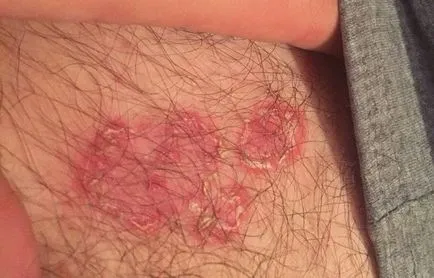 Tratamentul ciuperca în zona abdomenului