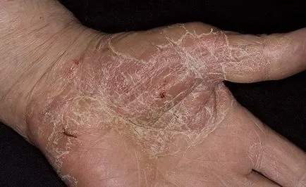 Cum de a vindeca remedii populare eczeme (rani elimina peeling) Cum de a vindeca remedii populare eczeme