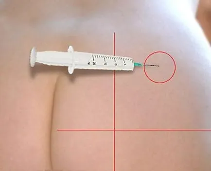Cum se obține o injecție