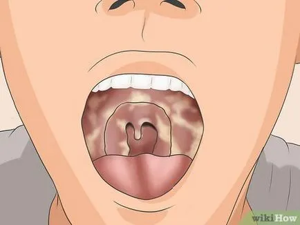 Ce este Strep Throat