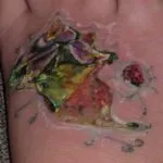 Cum și ce pentru a elimina un tatuaj