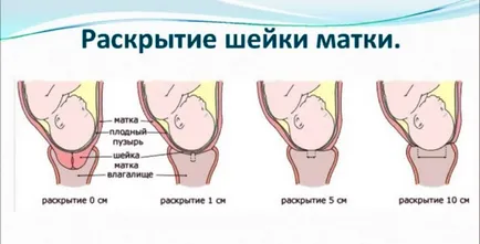 Cum de a accelera dilatare de col uterin