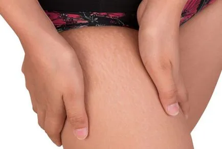Cum sa scapi de vergeturi pe coapse Cum sa scapi de vergeturi pe coapse