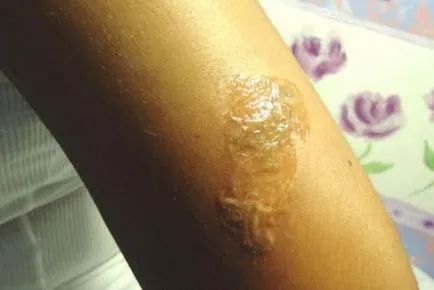 Cum și ce pentru a elimina un tatuaj