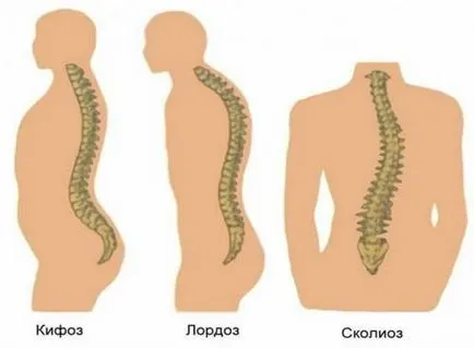 Cum să îndreptați coloanei vertebrale Cum să îndreptați coloanei vertebrale