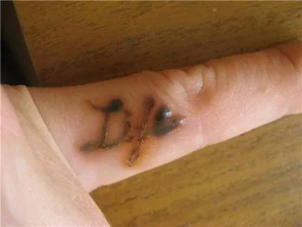 Cum și ce pentru a elimina un tatuaj