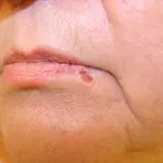 Ce este laparoscopia uterului Ce este laparoscopia uterului