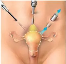 Ce este laparoscopia uterului
