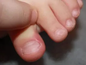 Pentru a trata o unghie incarnata acasă Pentru a trata o unghie incarnata acasă
