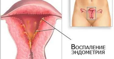 Tratamentul cronic endometritei de remedii populare