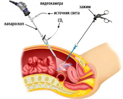 Ce este laparoscopia uterului Ce este laparoscopia uterului
