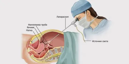 Ce este laparoscopia uterului
