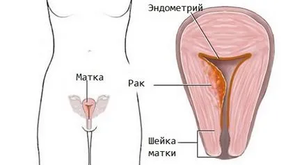 Ce este laparoscopia uterului