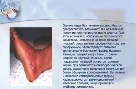 Ce este lymphostasis picioare