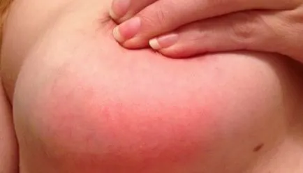 Ce este mastita și simptomele ei Ce este mastita și simptomele ei