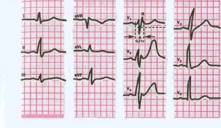 Ce este bloc cardiac incomplet