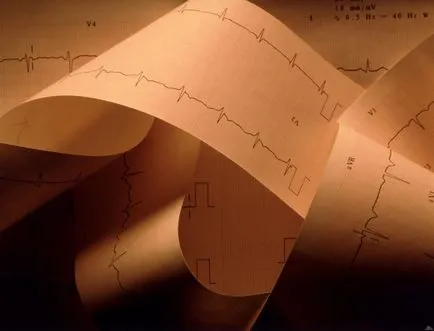 Ce este bloc cardiac incomplet