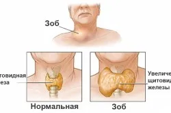 Volumul tiroidian la copii