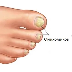 tratament de unghii onicomicozei tratament de unghii onicomicozei