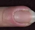 tratamentul paronychia
