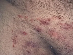 Tratamentul ciuperca în zona abdomenului